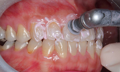 PMTC(プロによる歯のクリーニング)