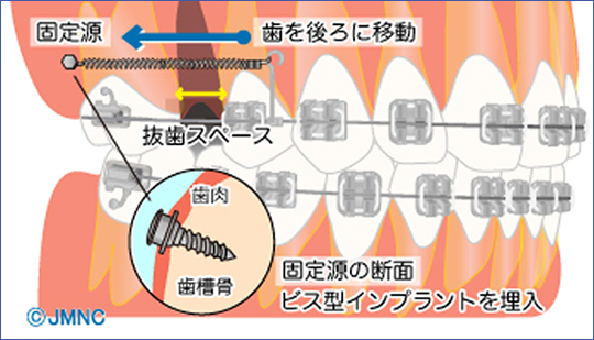 インプラント矯正