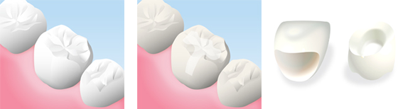 オールセラミッククラウン、インレー