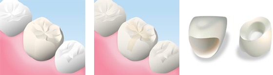 ハイブリッドセラミッククラウン、インレー