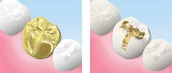 ゴールドクラウン、インレー