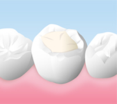 コンポジットレジン　(保険適用)