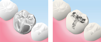 銀歯　(保険適用)